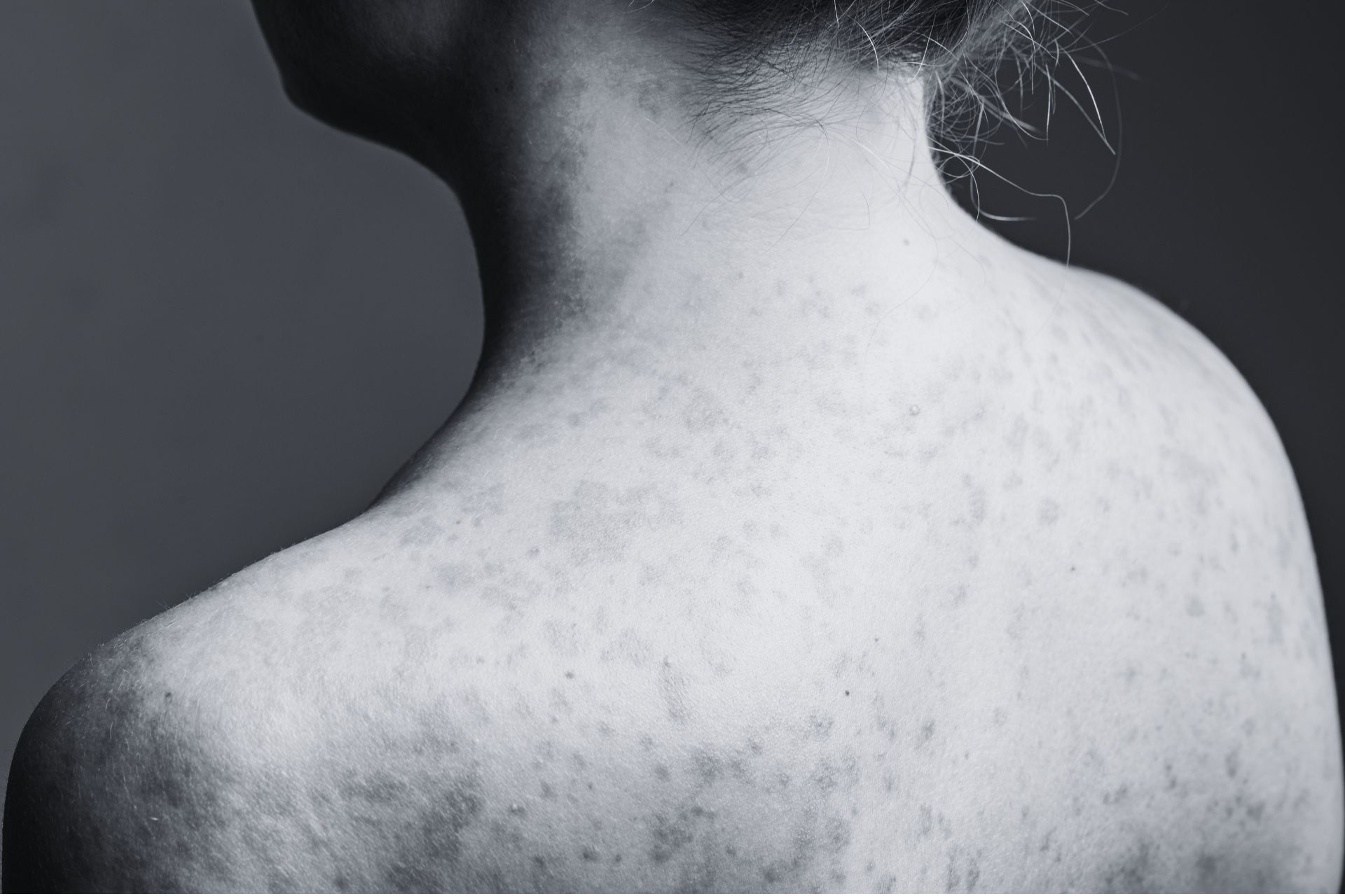 Close-up photograph showing a measles rash with small spots visible across a person's neck and upper back.
